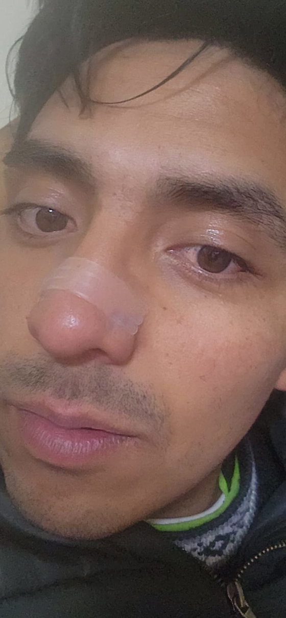 Cliente mostrando la tira nasal transparente puesta sobre la nariz